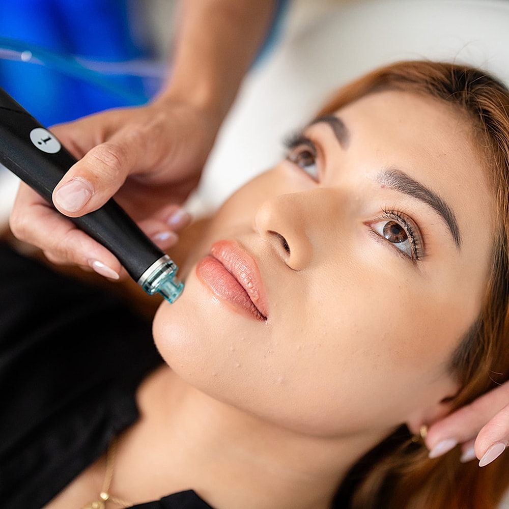 Woman receiving facial treatment with microneedling tool.