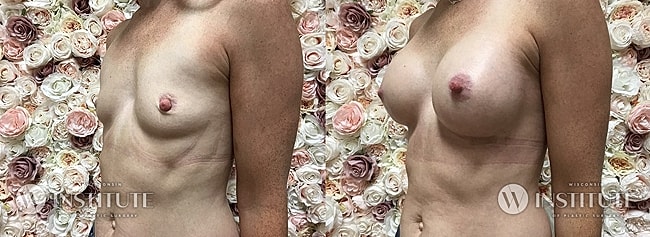 Before and after breast augmentation comparison photo.
