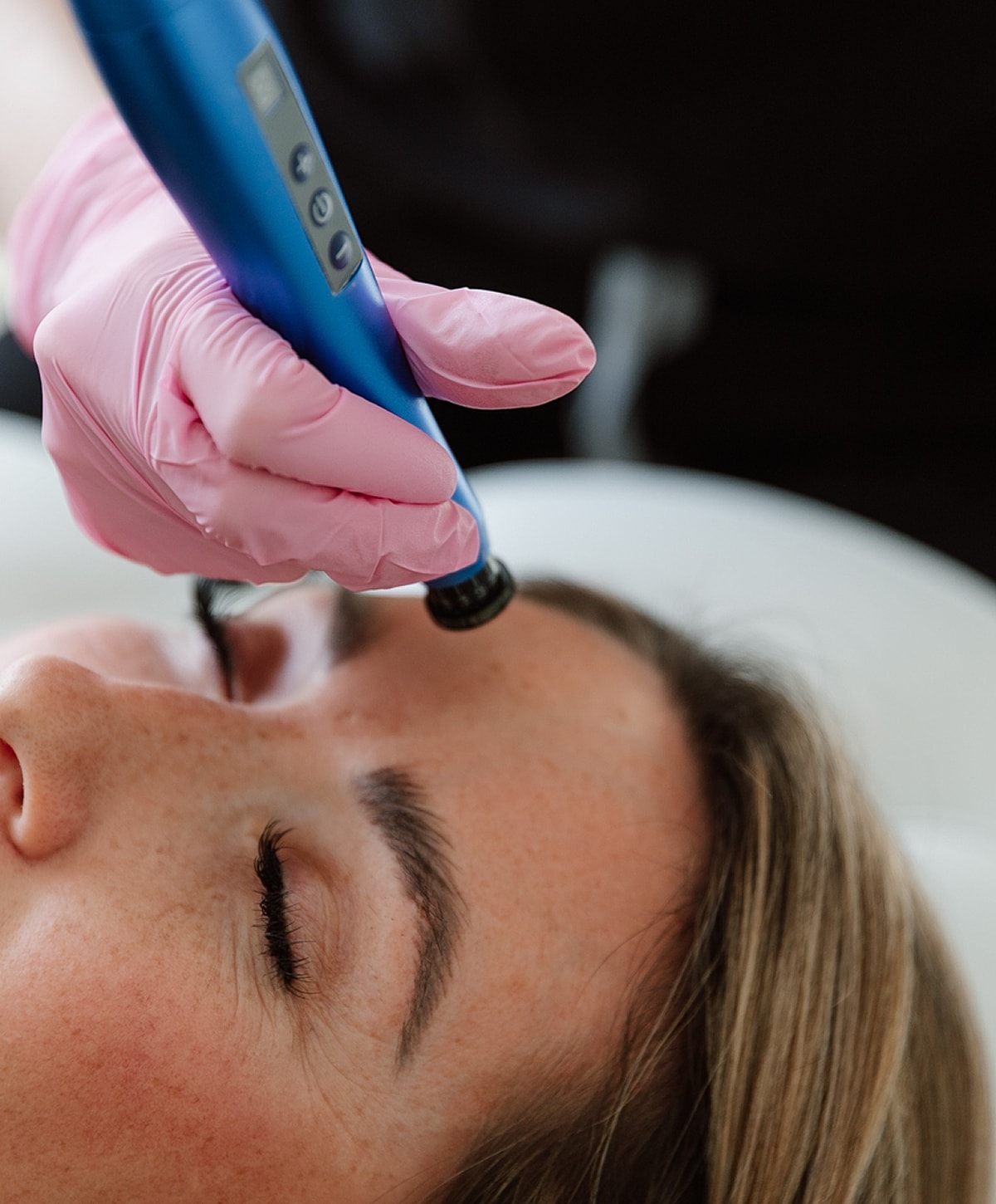 Skincare treatment in progress with microneedling device.