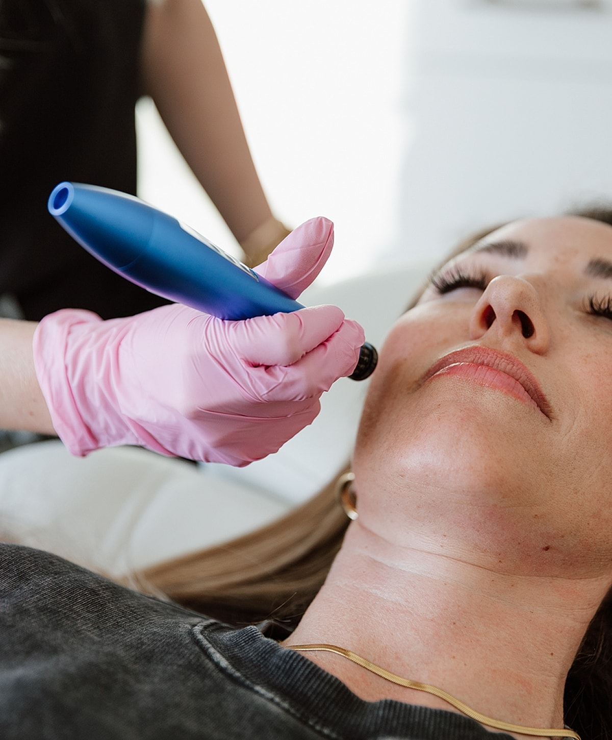 Skincare treatment in progress with microneedling device.