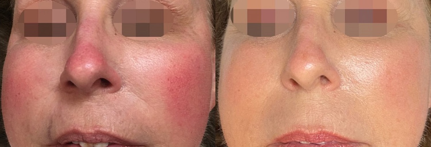 Before and after facial treatment comparison.