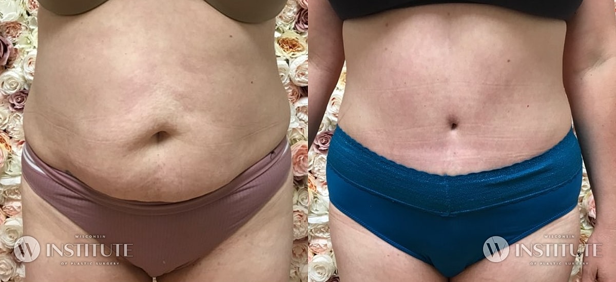 Tummy Tuck Before & After