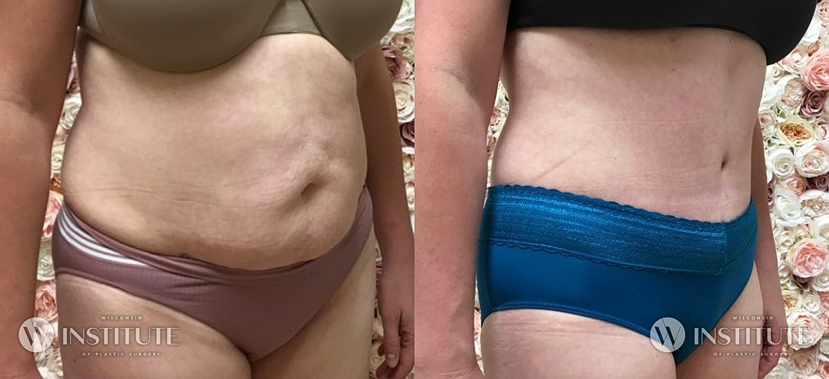 Tummy Tuck Before & After