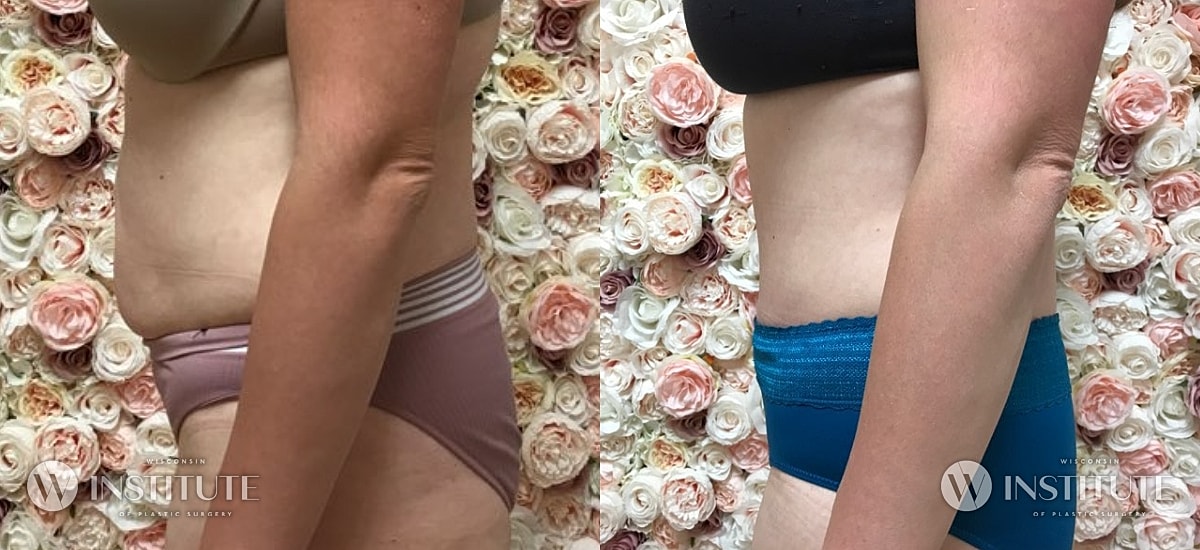 Tummy Tuck Before & After