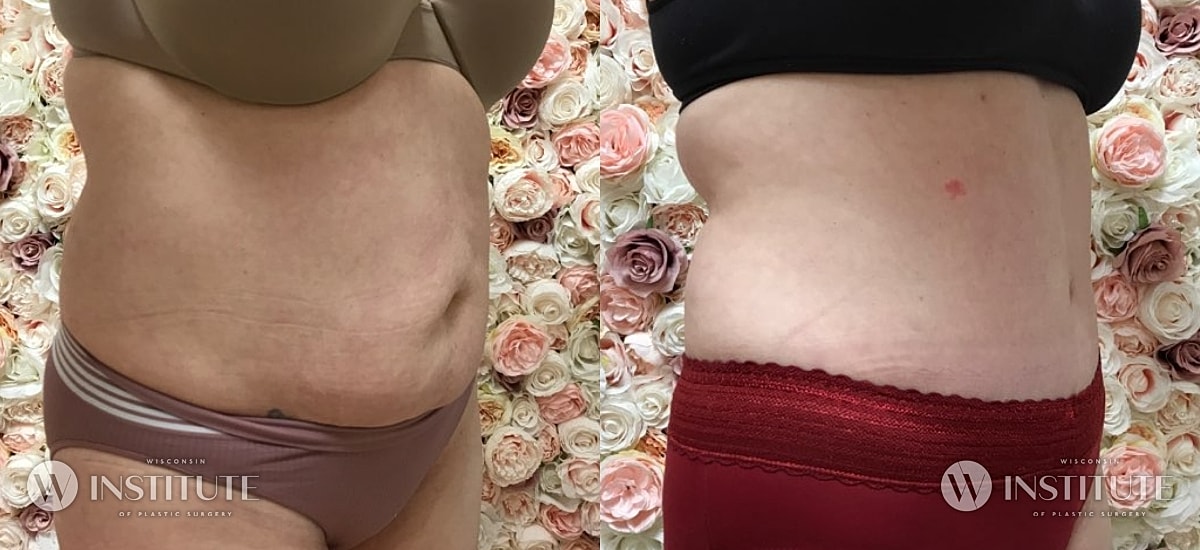 Tummy Tuck Before & After