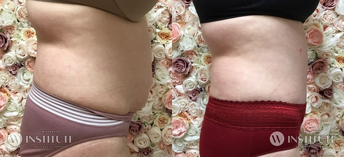 Tummy Tuck Before & After