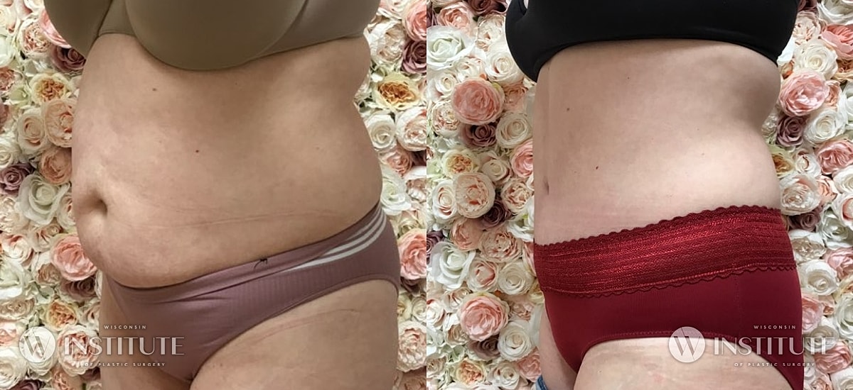 Tummy Tuck Before & After