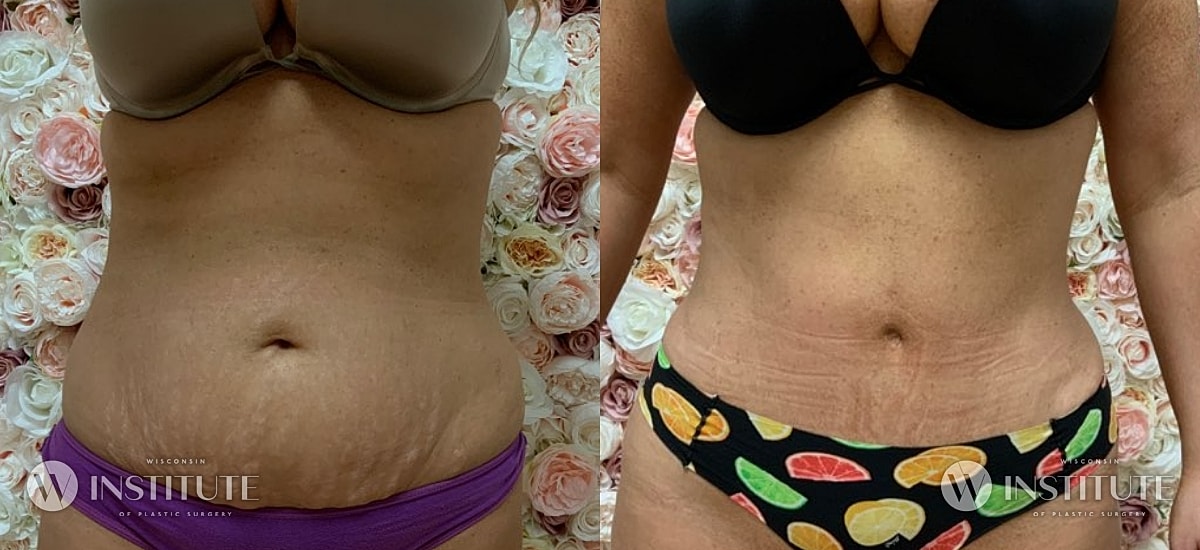 Tummy Tuck Before & After