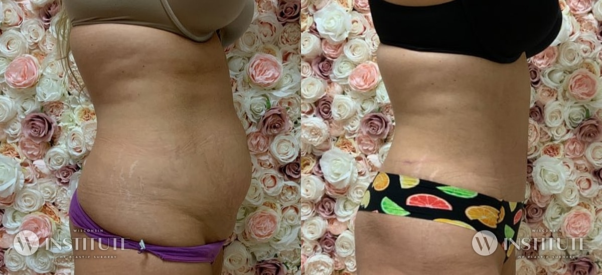 Tummy Tuck Before & After