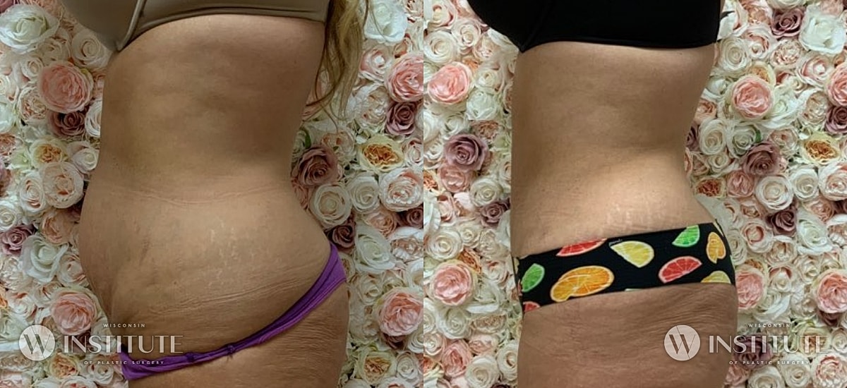 Tummy Tuck Before & After