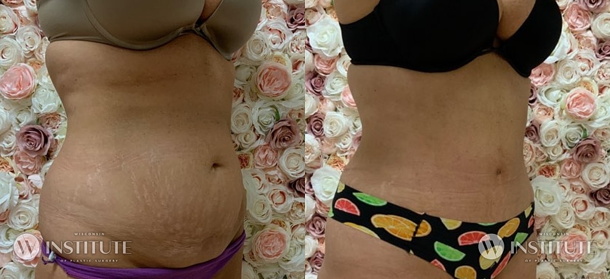 Tummy Tuck Before & After