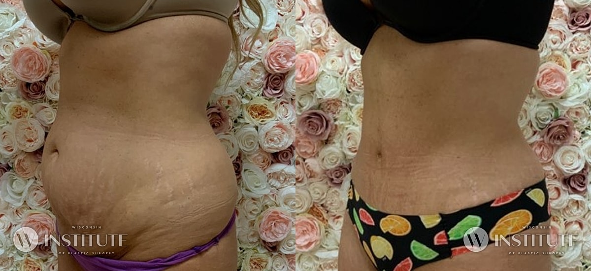 Tummy Tuck Before & After