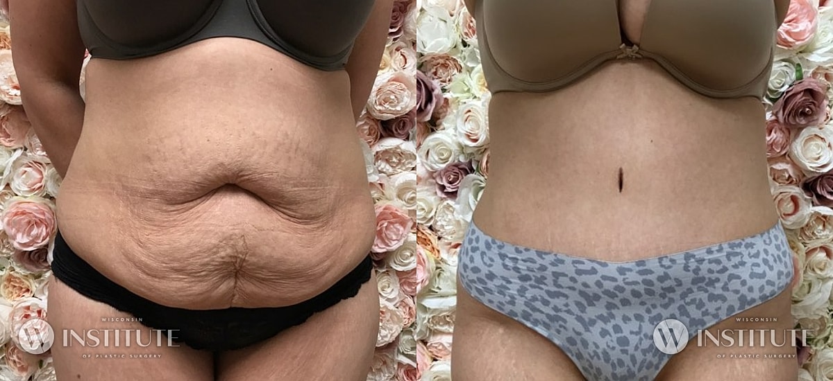 Tummy Tuck Before & After