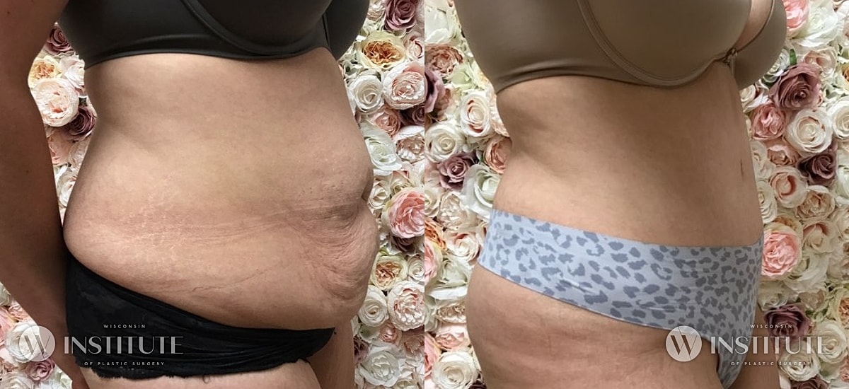 Tummy Tuck Before & After