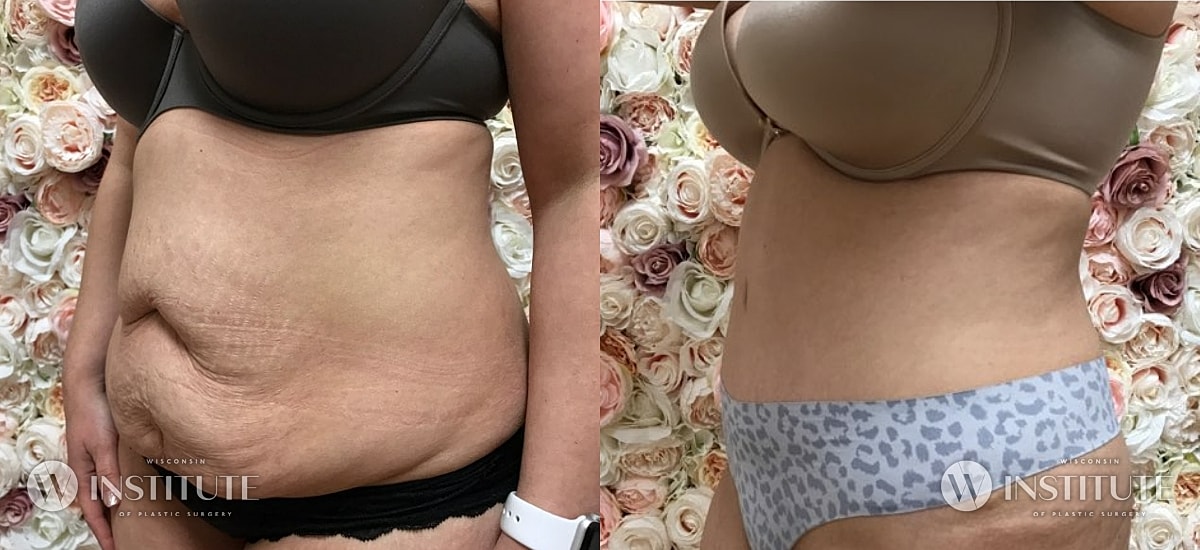 Tummy Tuck Before & After