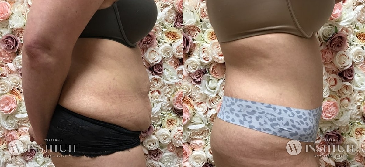 Tummy Tuck Before & After
