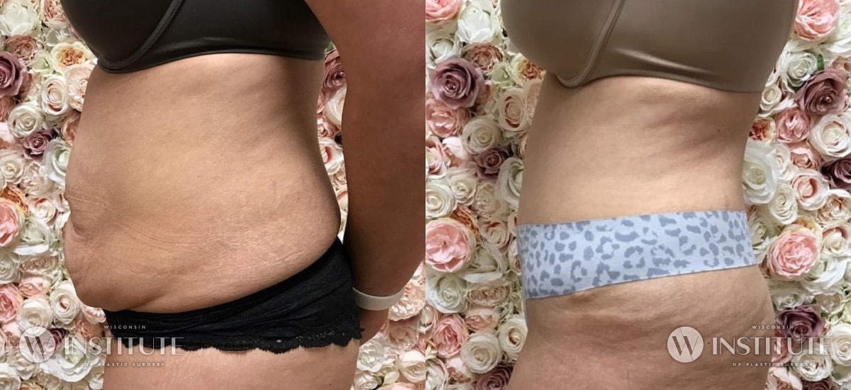 Tummy Tuck Before & After