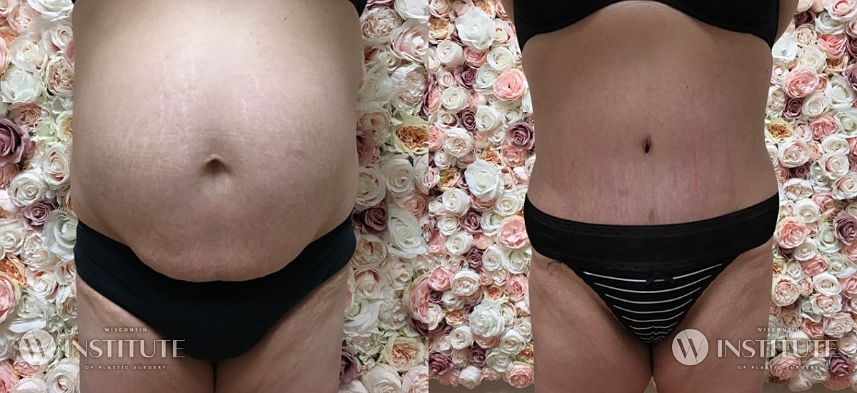 Tummy Tuck Before & After