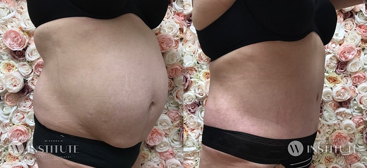 Tummy Tuck Before & After