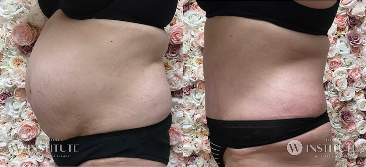Tummy Tuck Before & After