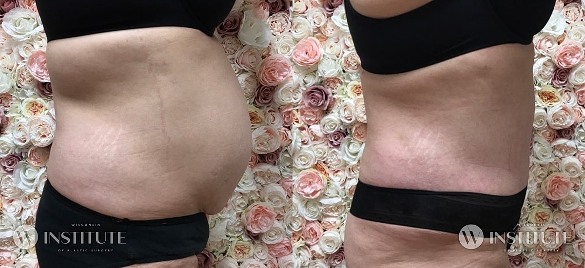 Tummy Tuck Before & After