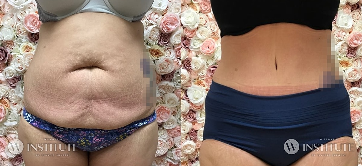 Tummy Tuck Before & After