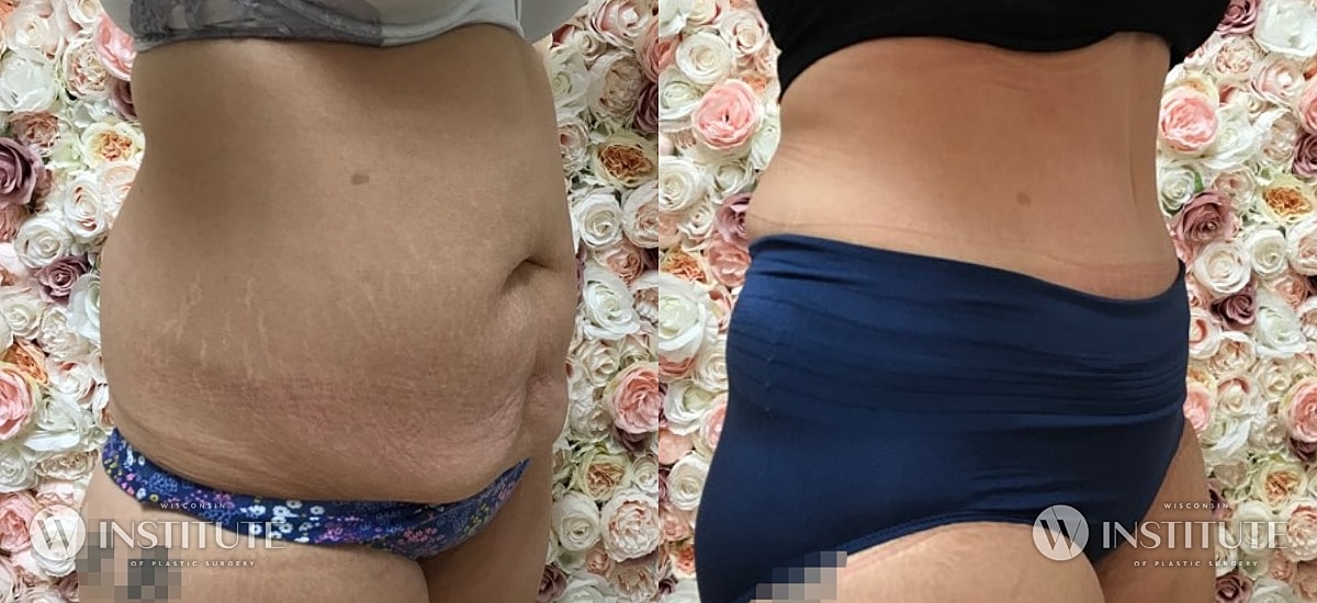 Tummy Tuck Before & After