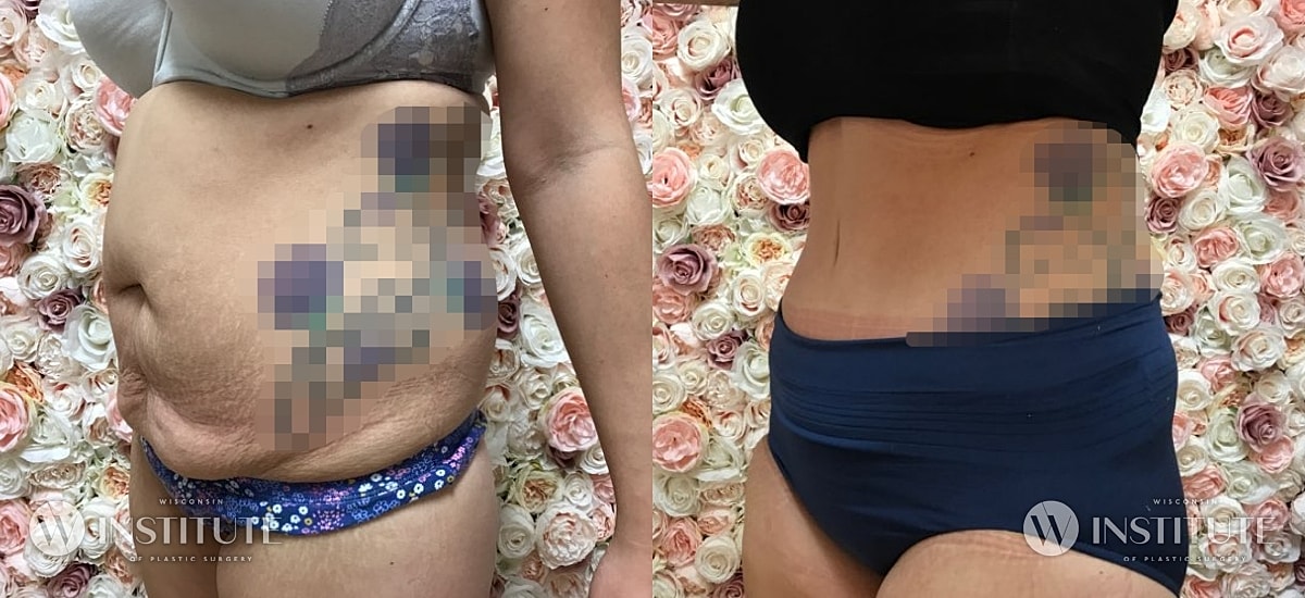 Tummy Tuck Before & After