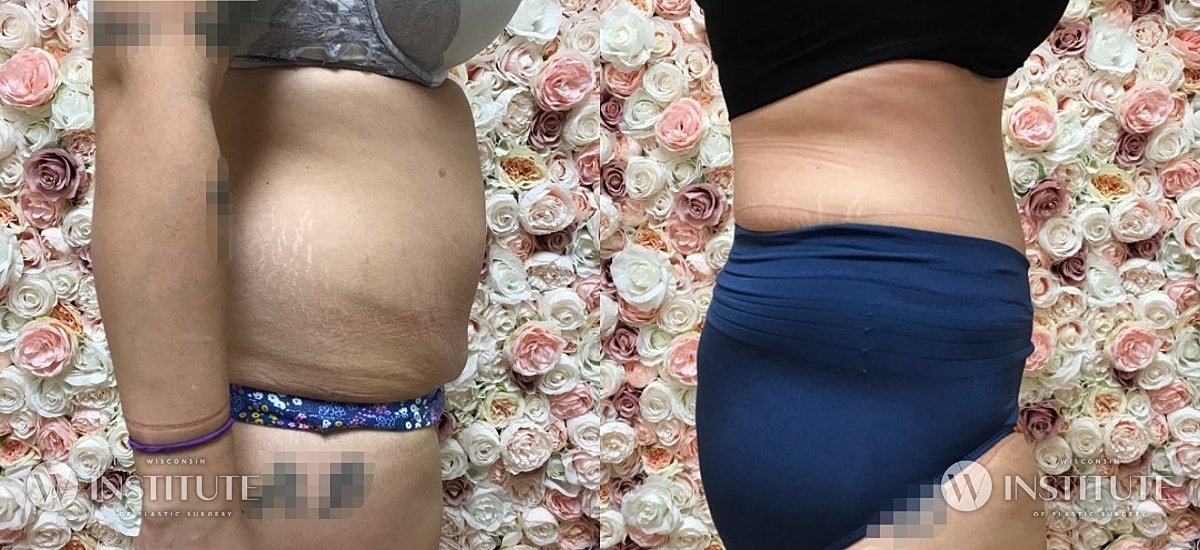 Tummy Tuck Before & After