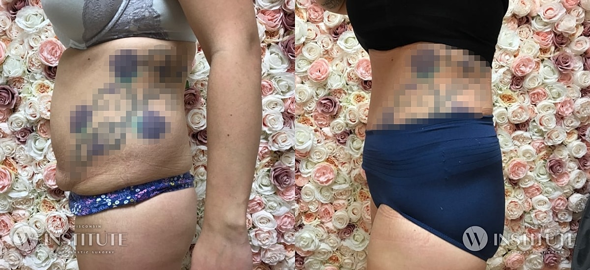 Tummy Tuck Before & After