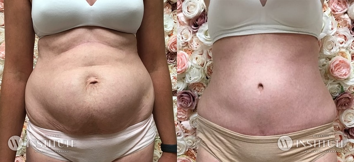 Tummy Tuck Before & After