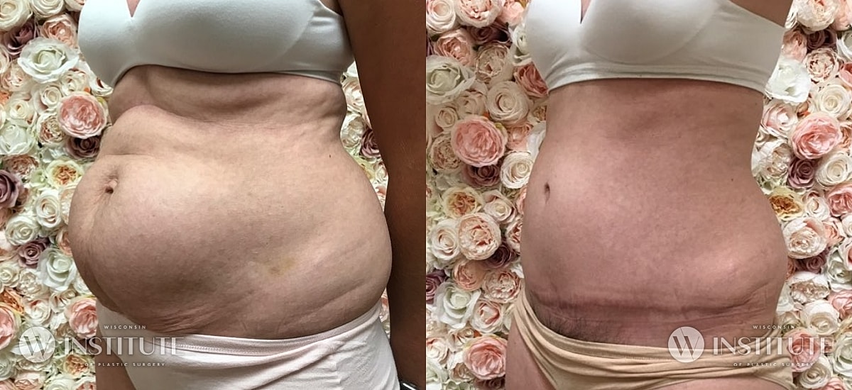 Tummy Tuck Before & After
