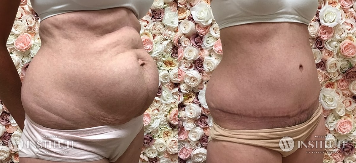 Tummy Tuck Before & After