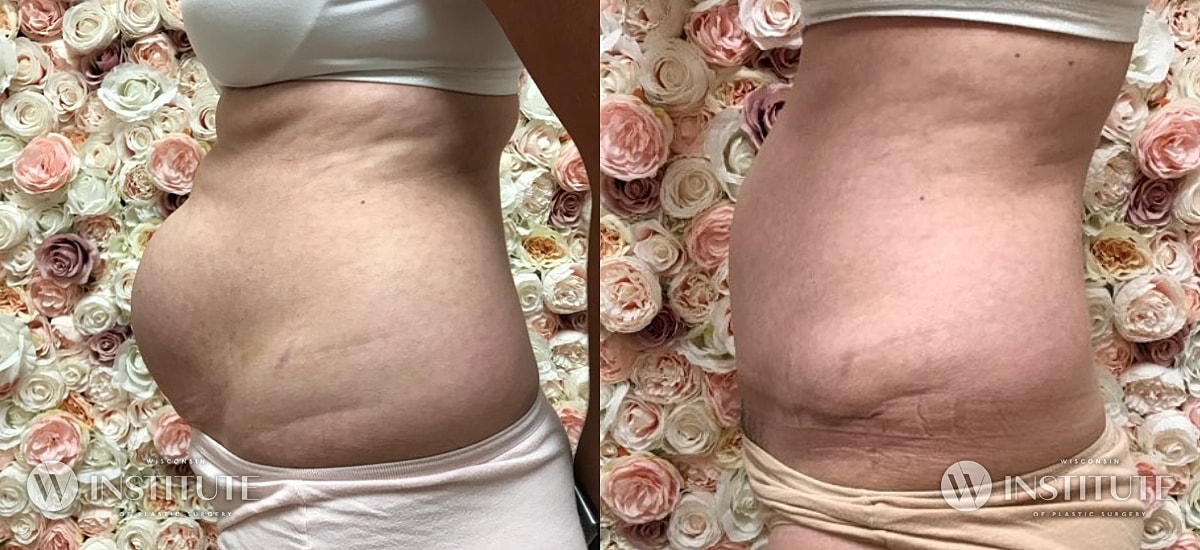 Tummy Tuck Before & After