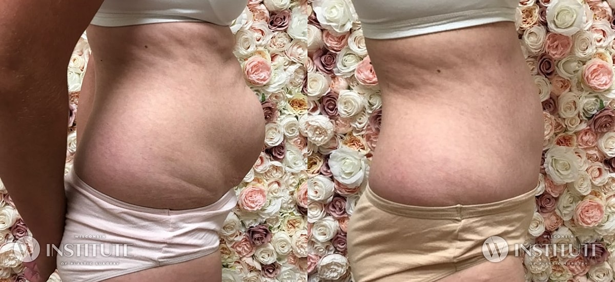 Tummy Tuck Before & After