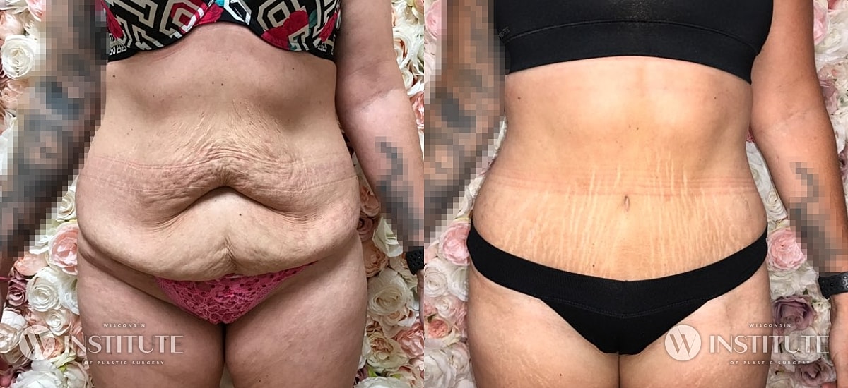 Tummy Tuck Before & After