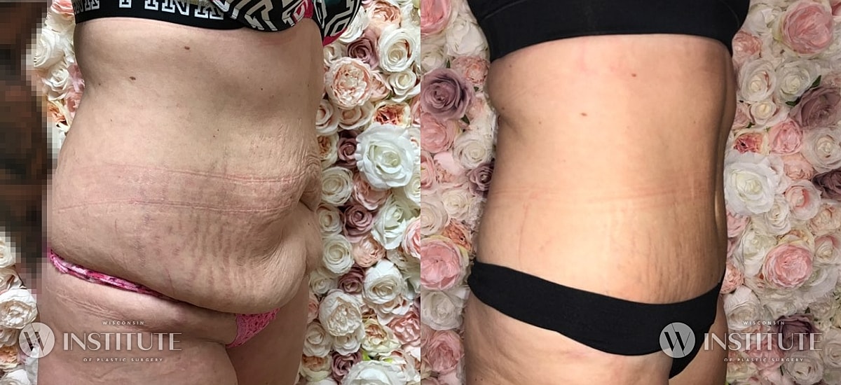Tummy Tuck Before & After
