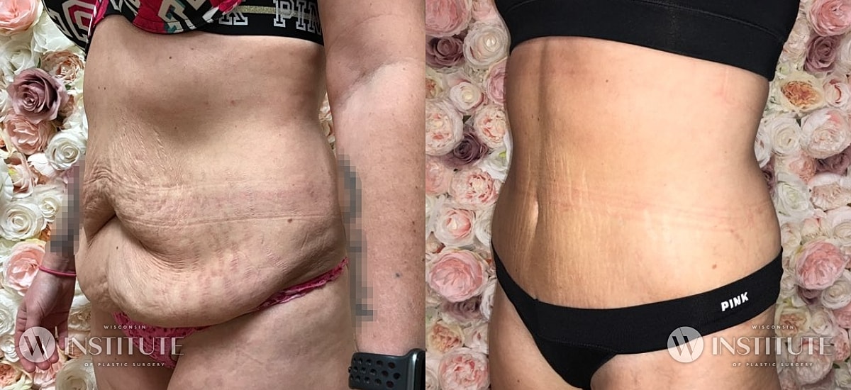 Tummy Tuck Before & After