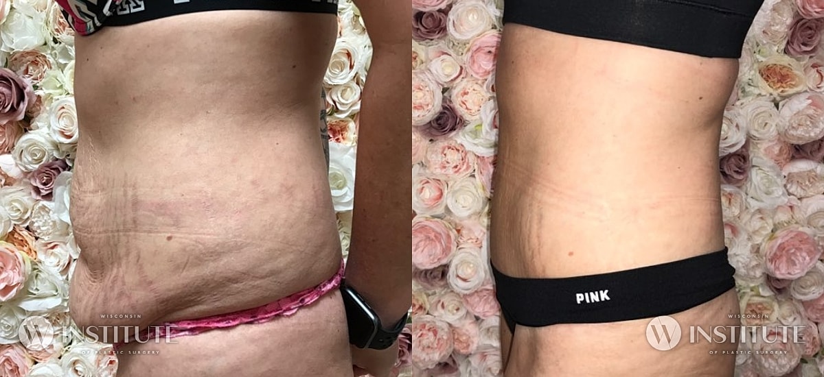 Tummy Tuck Before & After