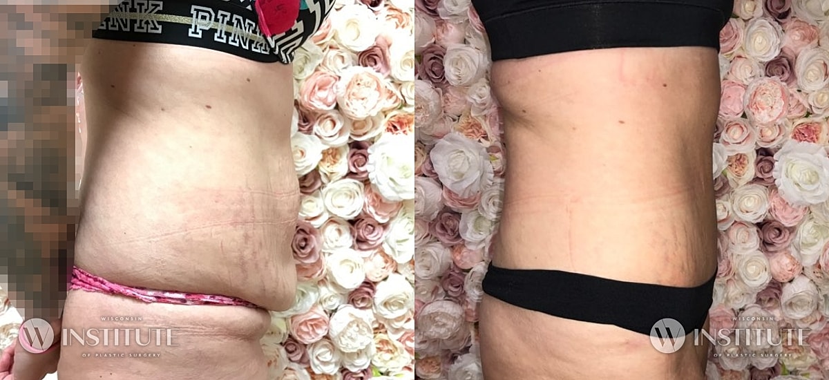 Tummy Tuck Before & After