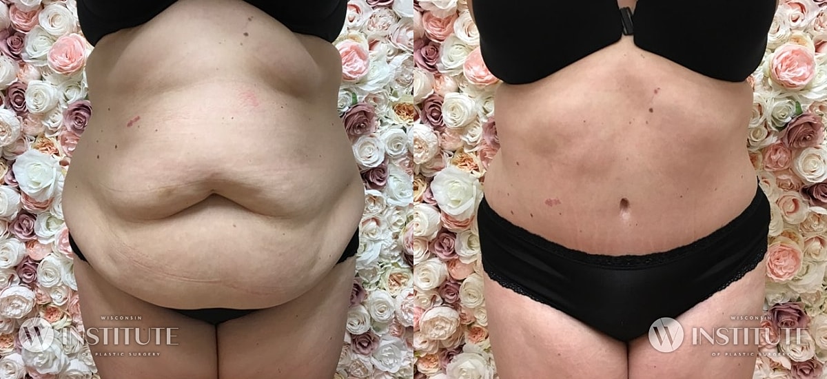Tummy Tuck Before & After