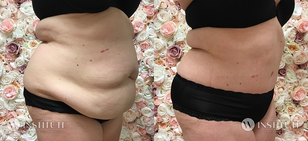 Tummy Tuck Before & After