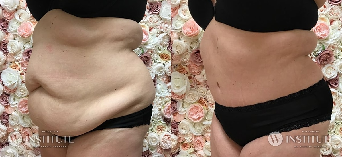 Tummy Tuck Before & After