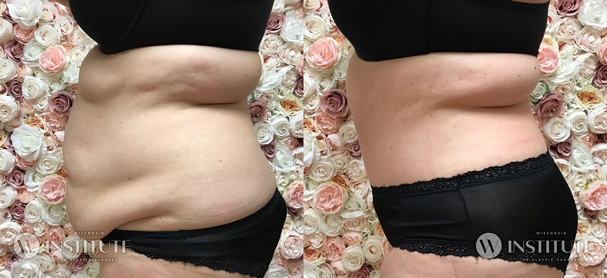 Tummy Tuck Before & After