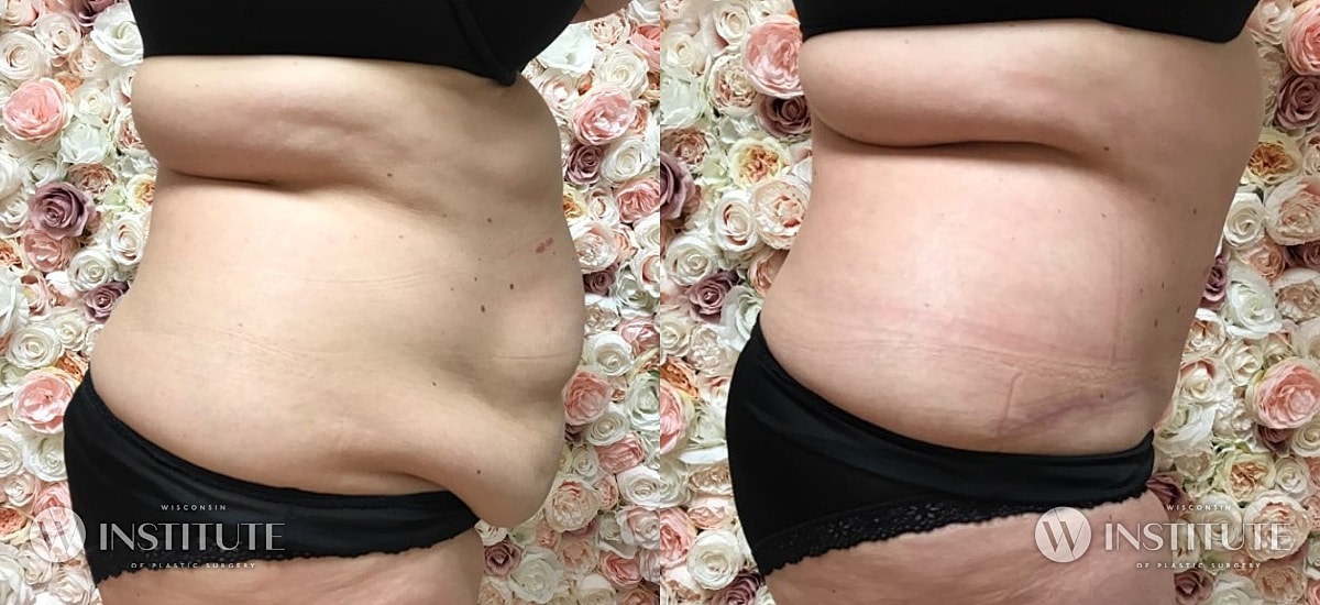 Tummy Tuck Before & After