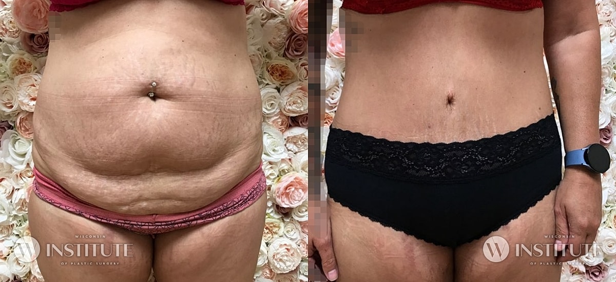 Tummy Tuck Before & After