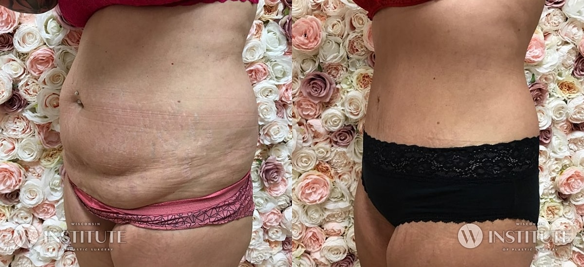 Tummy Tuck Before & After