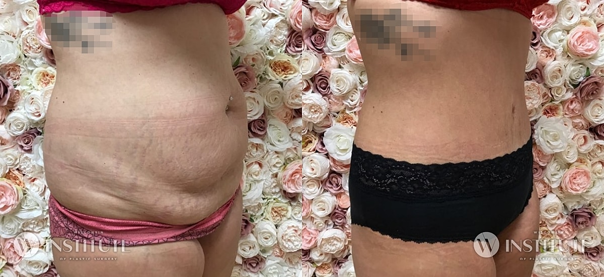 Tummy Tuck Before & After