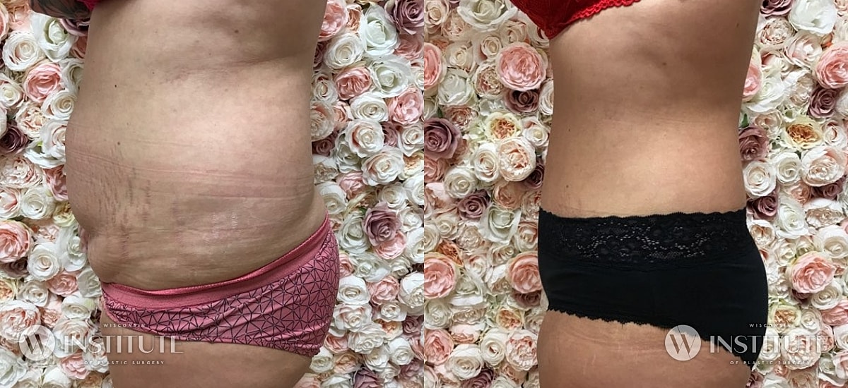 Tummy Tuck Before & After