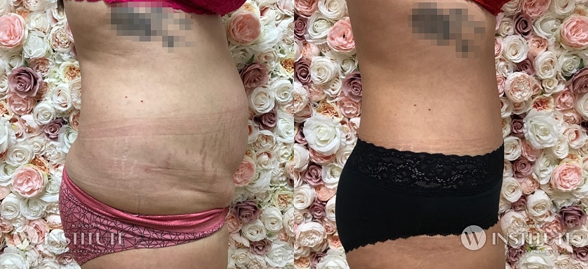 Tummy Tuck Before & After